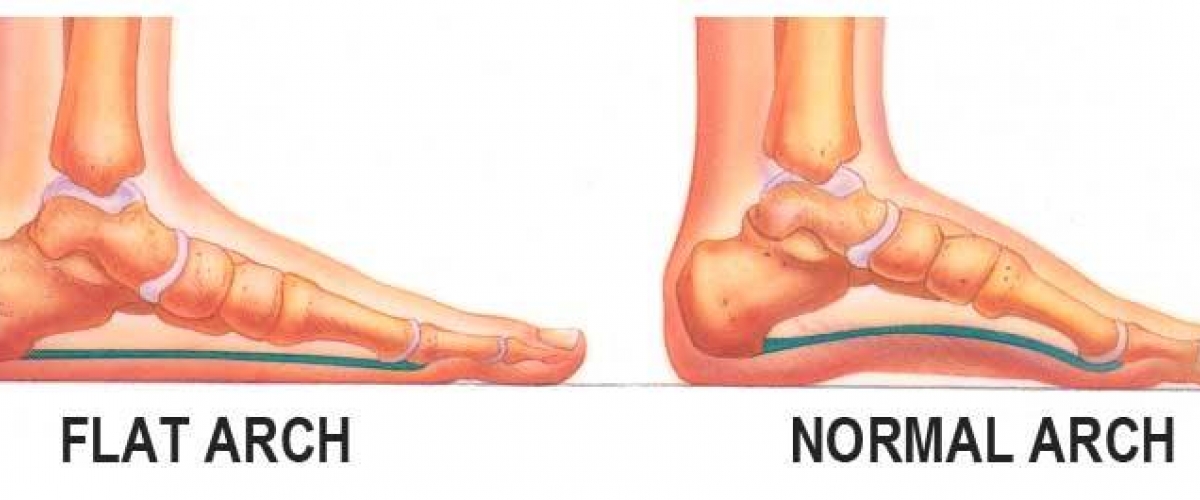 underpronation and flat feet